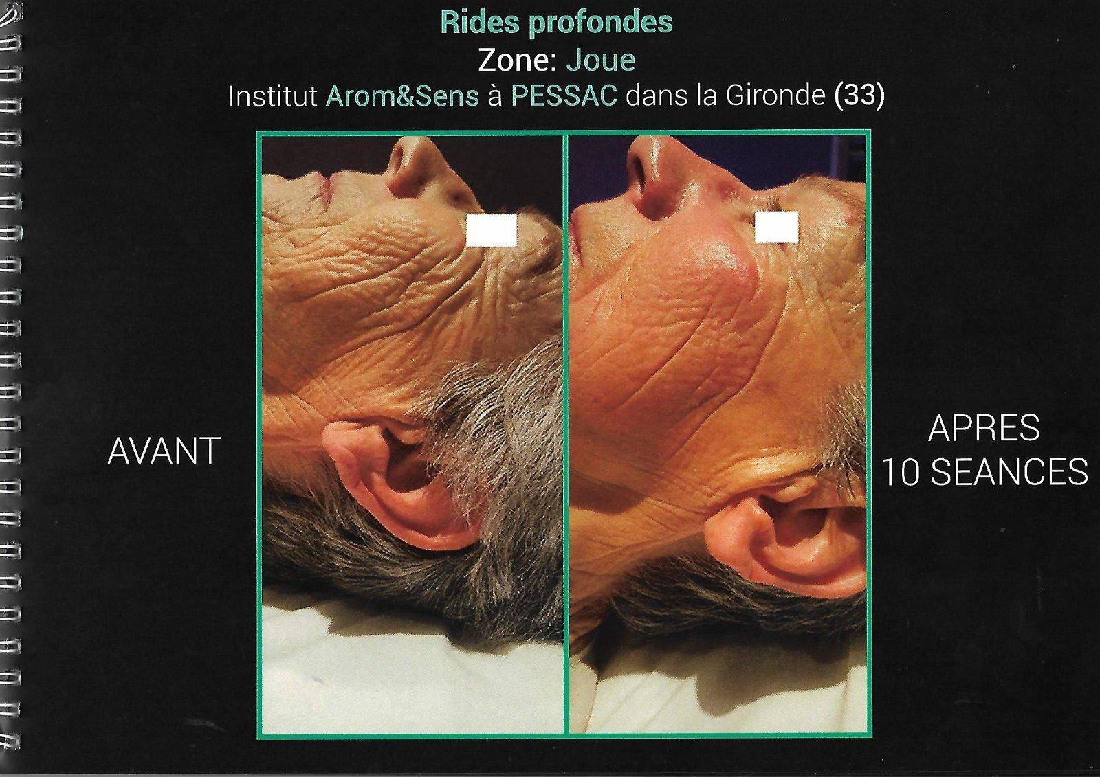 rides profondes